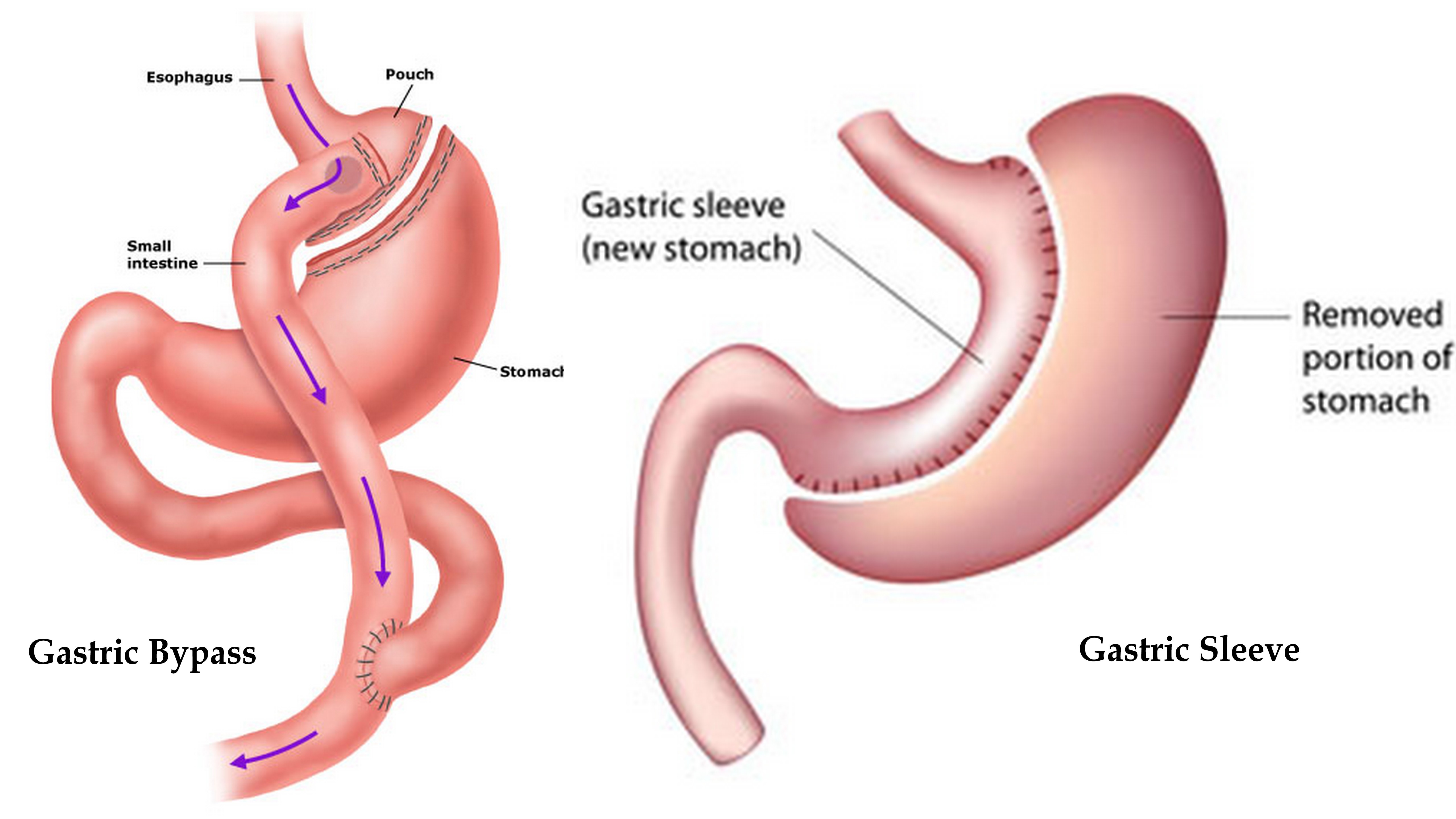 Long Term Effects Gastric Bypass